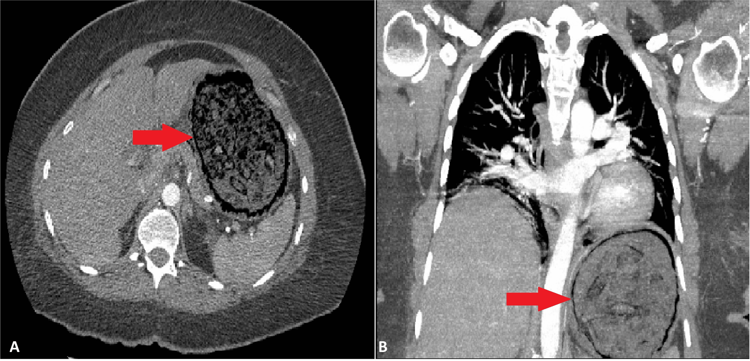 Cureus Surgical Management of Emphysematous Gastritis in a Postpartum