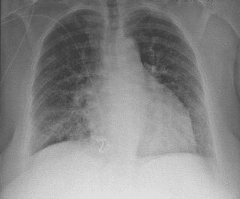 Cureus Severe Leptospirosis A Case Report