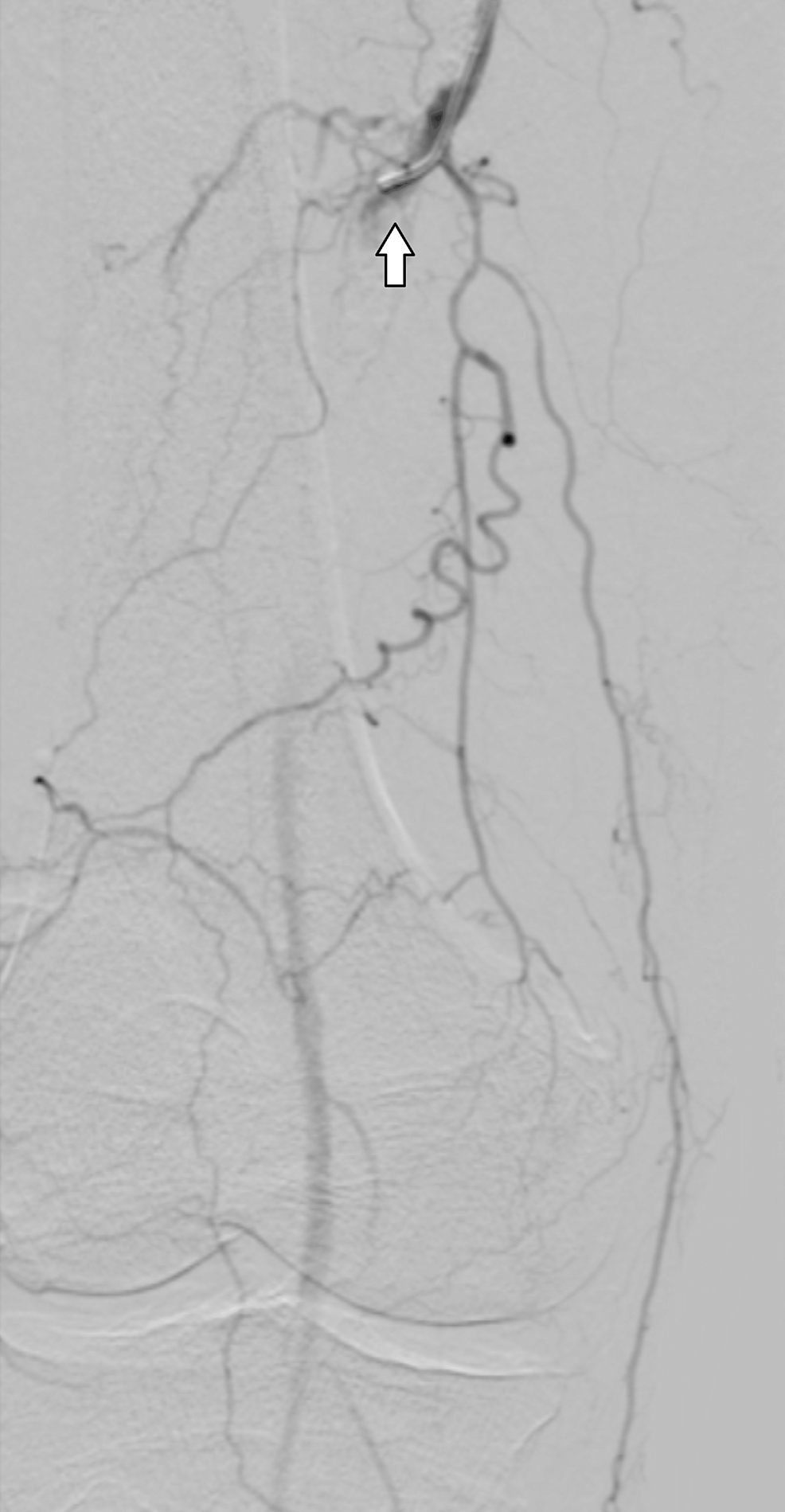 Recent Myocardial Infarction And Acute Heparin Induced Thrombocytopenia