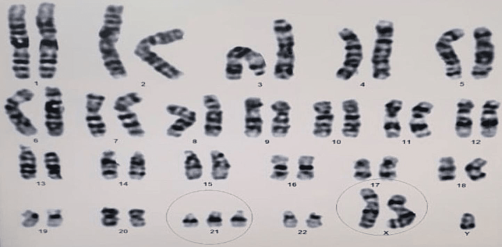 klinefelter syndrome karyotype