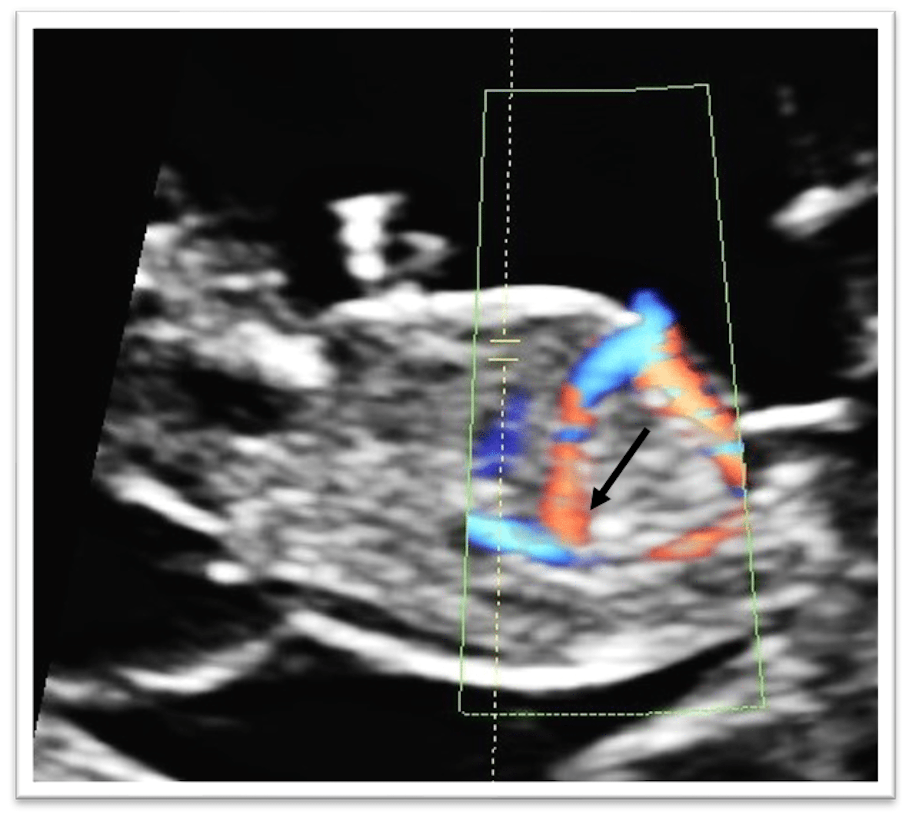 Cureus | The Incidence of the Agenesis of Fetal Ductus Venosus at the ...