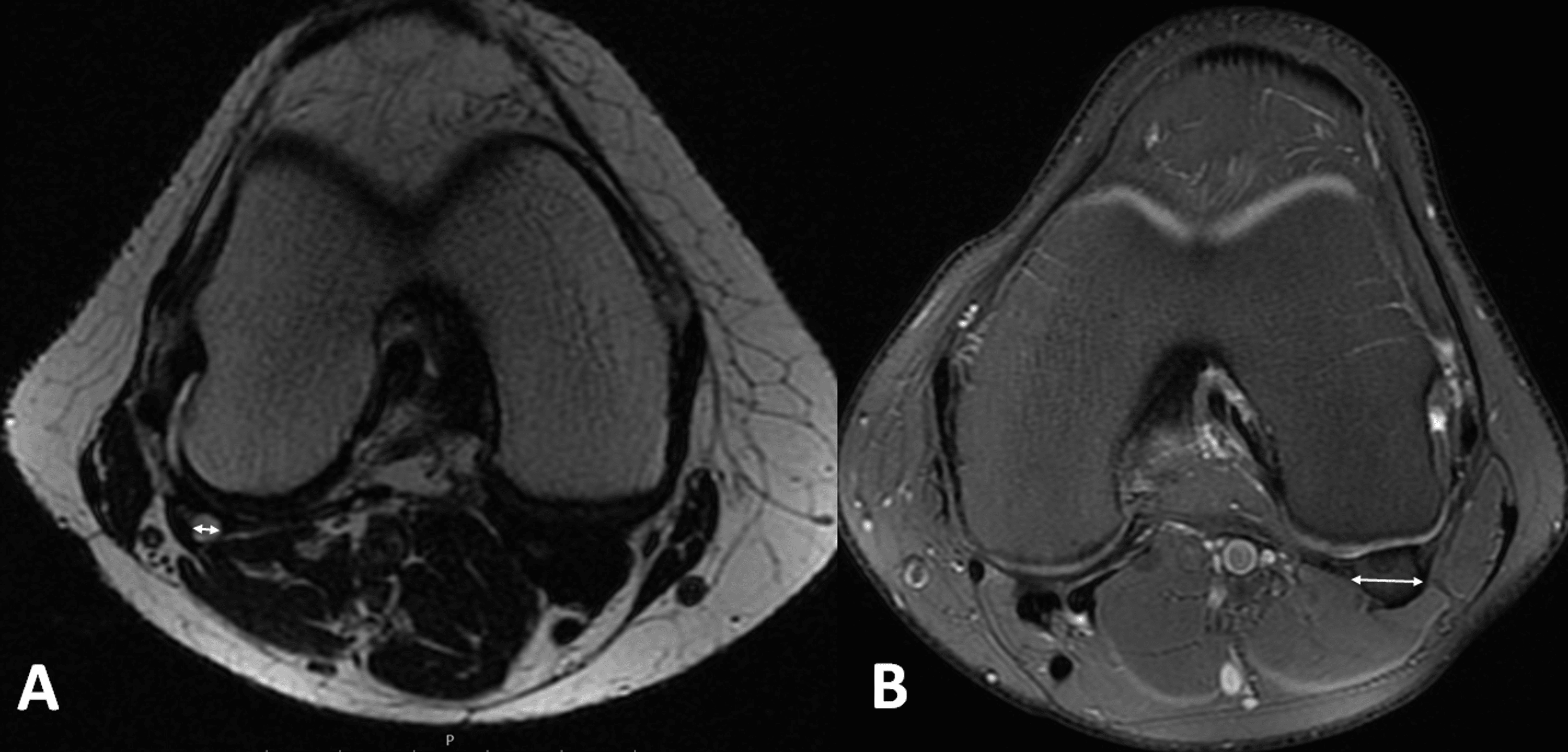 Cureus | Prevalence and Radiological Characteristics of the Fabella in ...