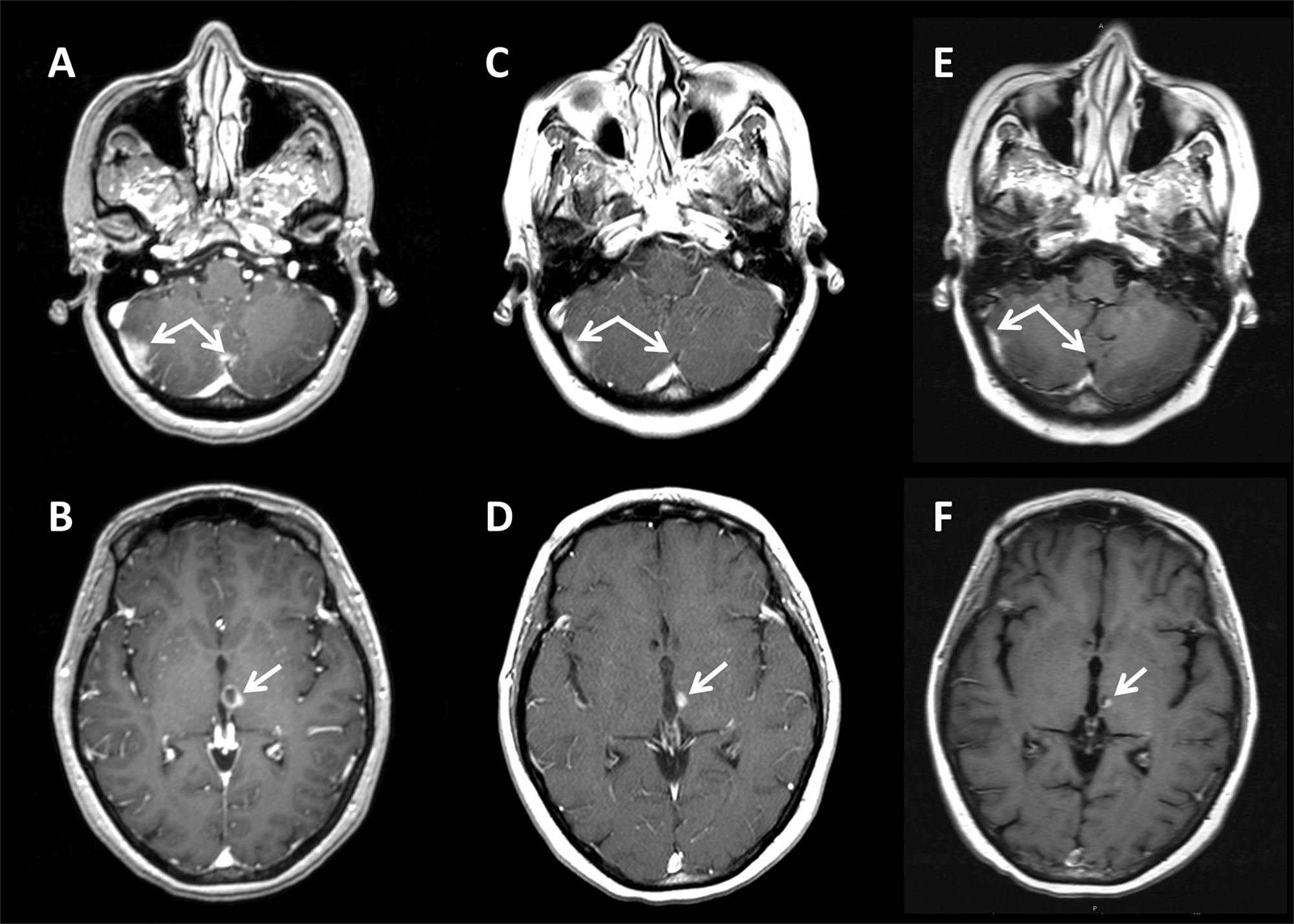 Cureus | Stereotactic Radiosurgery as Part of Multimodal Treatment in a ...