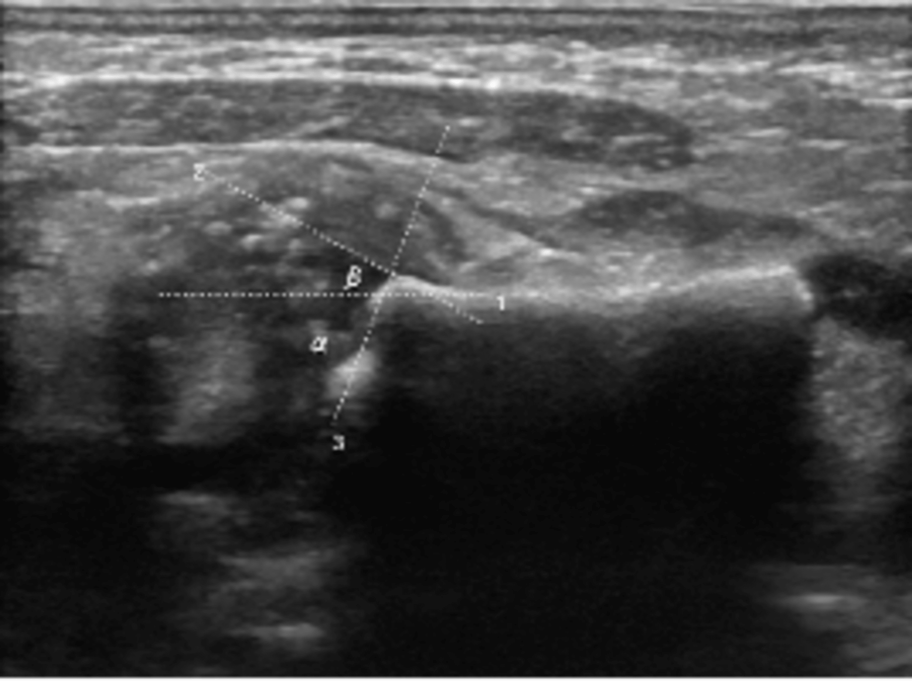 Cureus | A Case of Rhizomelic Chondrodysplasia Punctata in a Neonate