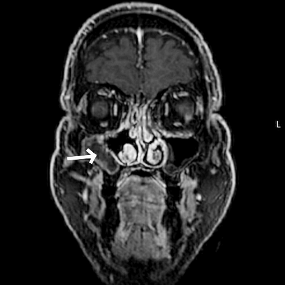 MRI-after-endoscopic-sinus-surgery-right-maxillary-sinus-(white arrow).