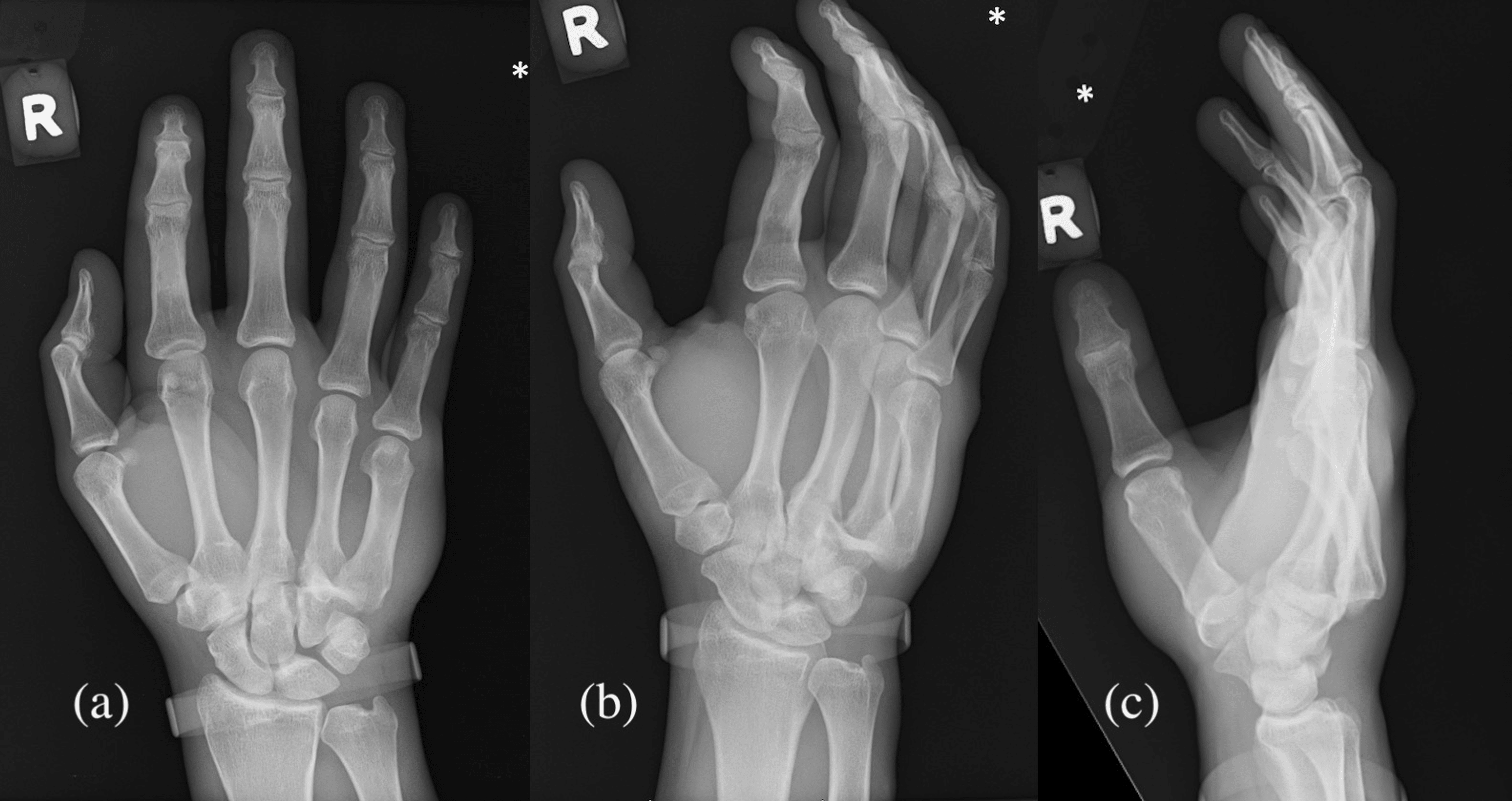 Conservative Management Of The Ring And Little Finger Carpometacarpal ...