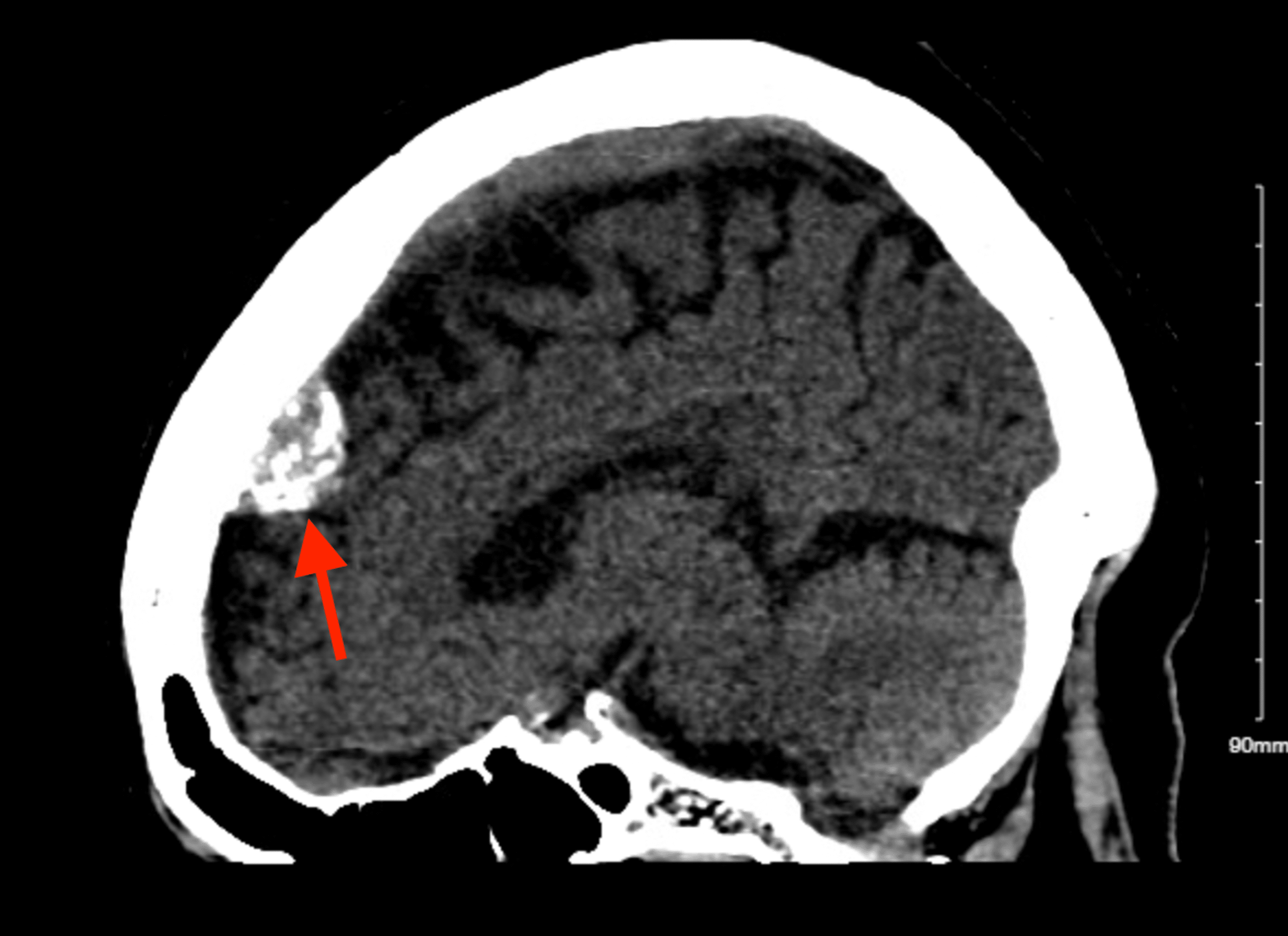 Cureus Gastrointestinal Stromal Tumor With a Rare Associated