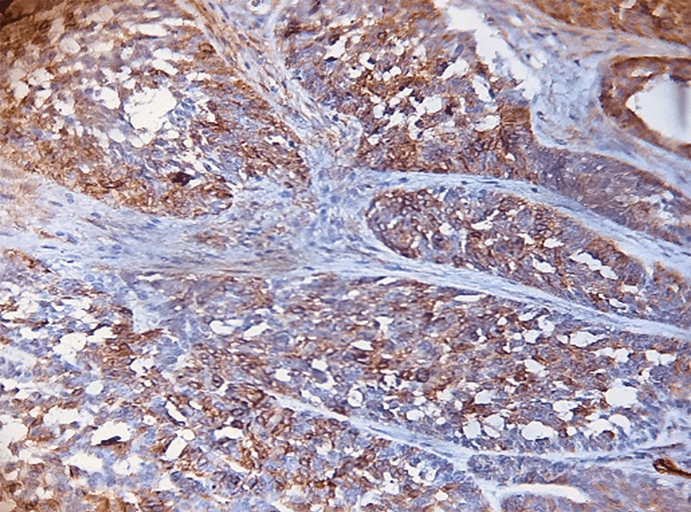 Immunohistochemical Evaluation Of S100, Alpha-Smooth Muscle Actin ...