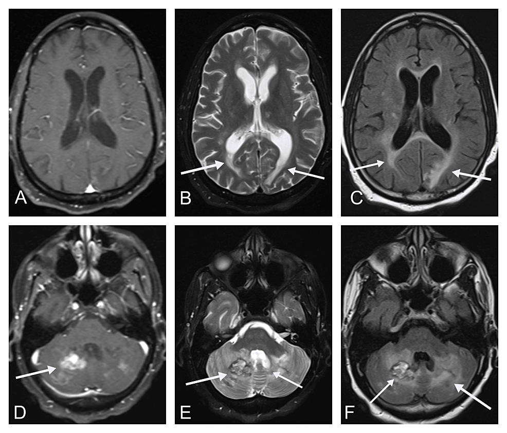 Cureus | Posterior Reversible Encephalopathy Syndrome With Hemorrhagic ...