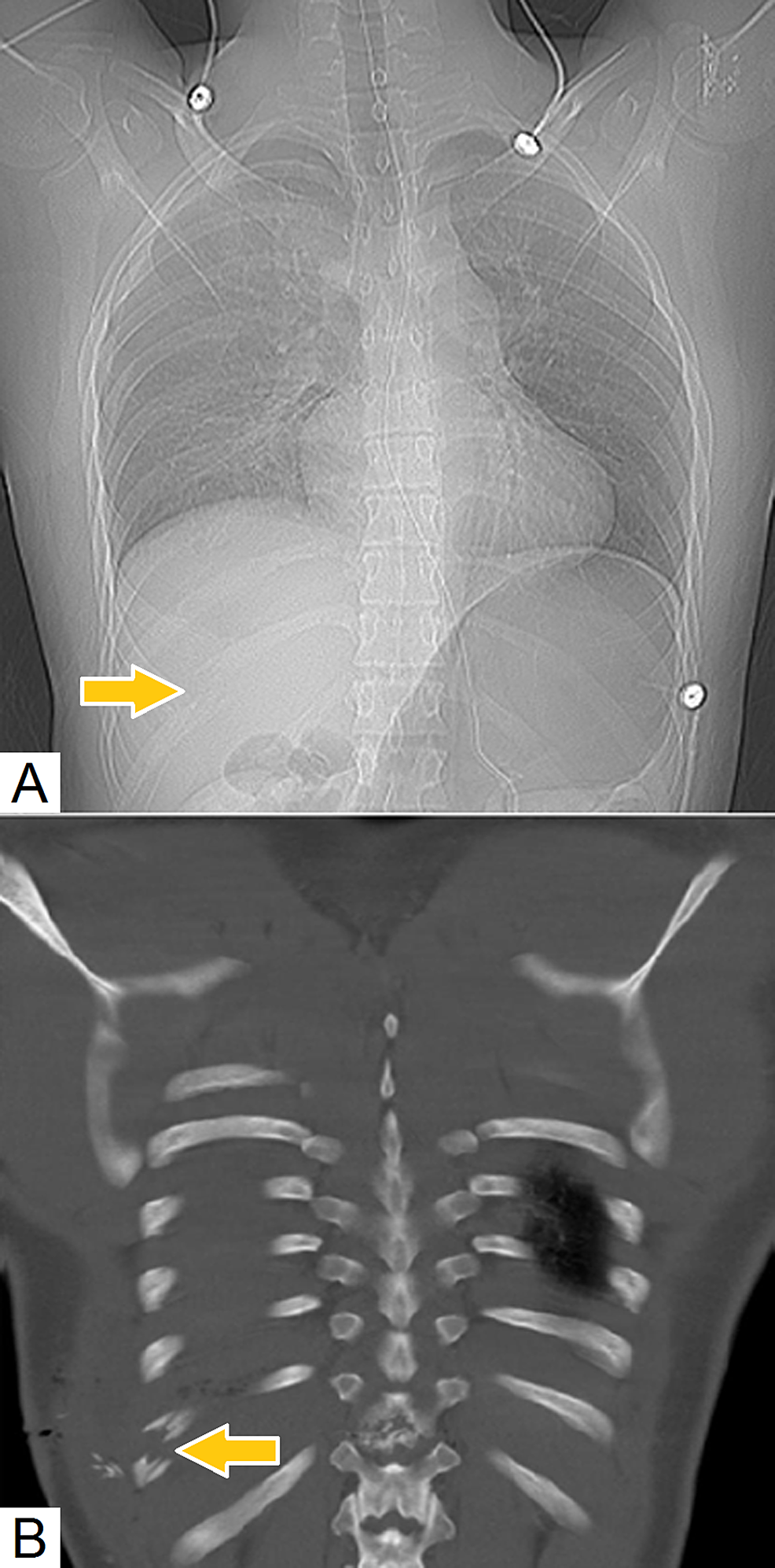 Cureus Diagnostic Accuracy of Computed Tomography Scout Film and
