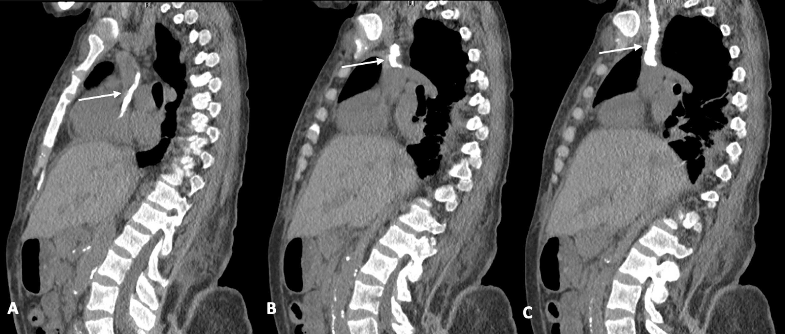 Cureus Calcified CatheterRelated Fibrin Sheath Forms Large