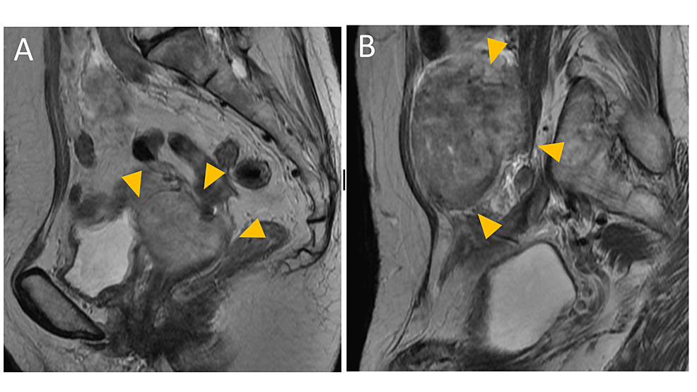 An Unusual Case of Vaginal Myoma Presenting with Postmenopausal