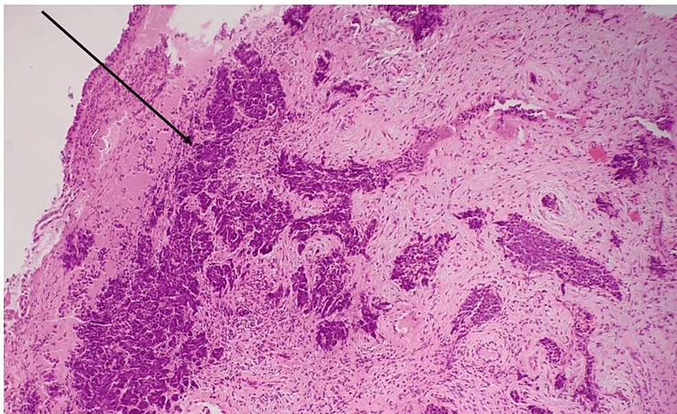 A Rare Case Of Small Cell Neuroendocrine Cancer Of The Cervix An Unexpected Diagnosis Cureus 1906