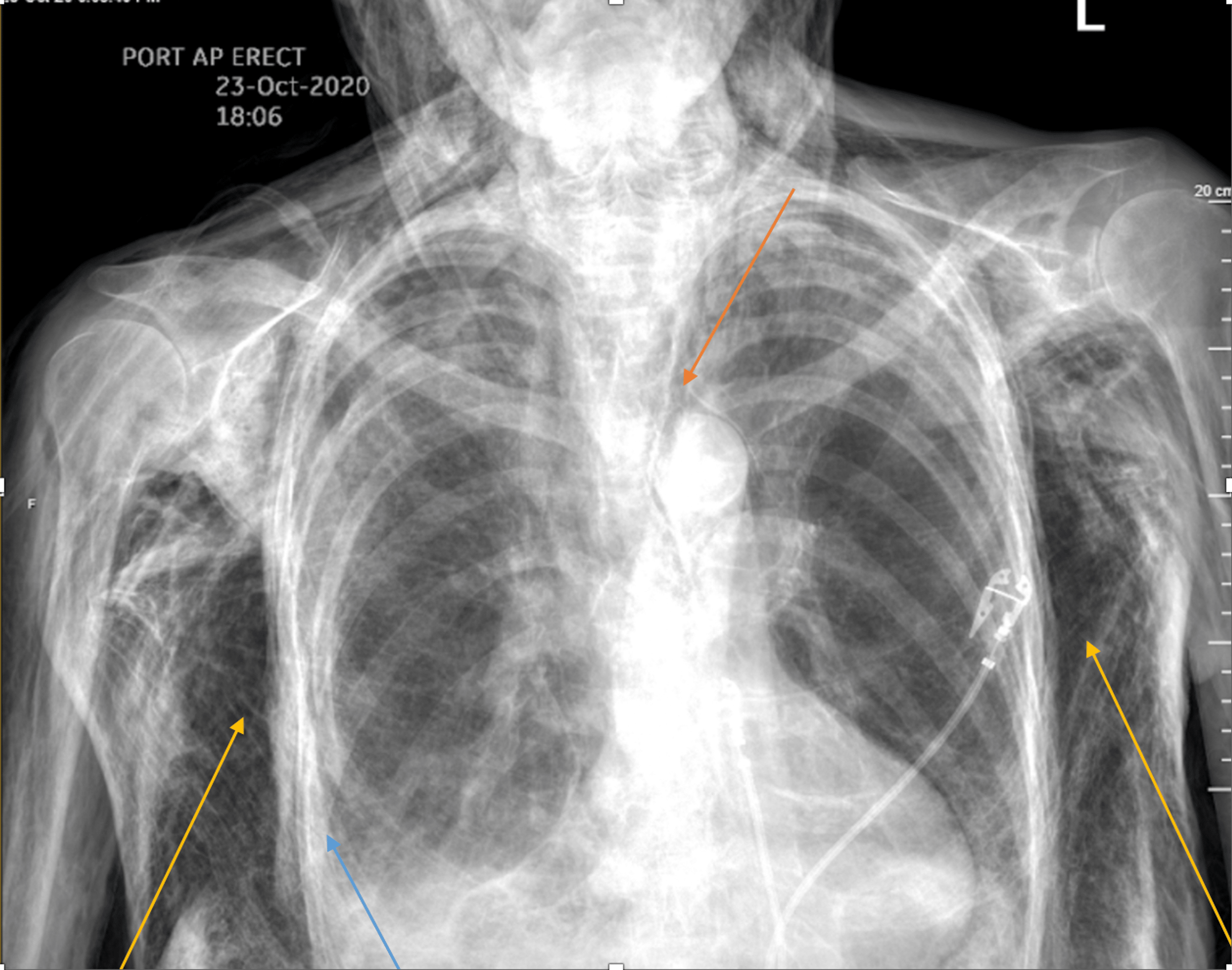 The Chest X Ray Demonstrates Extensive Subcutaneous Emphysema And My