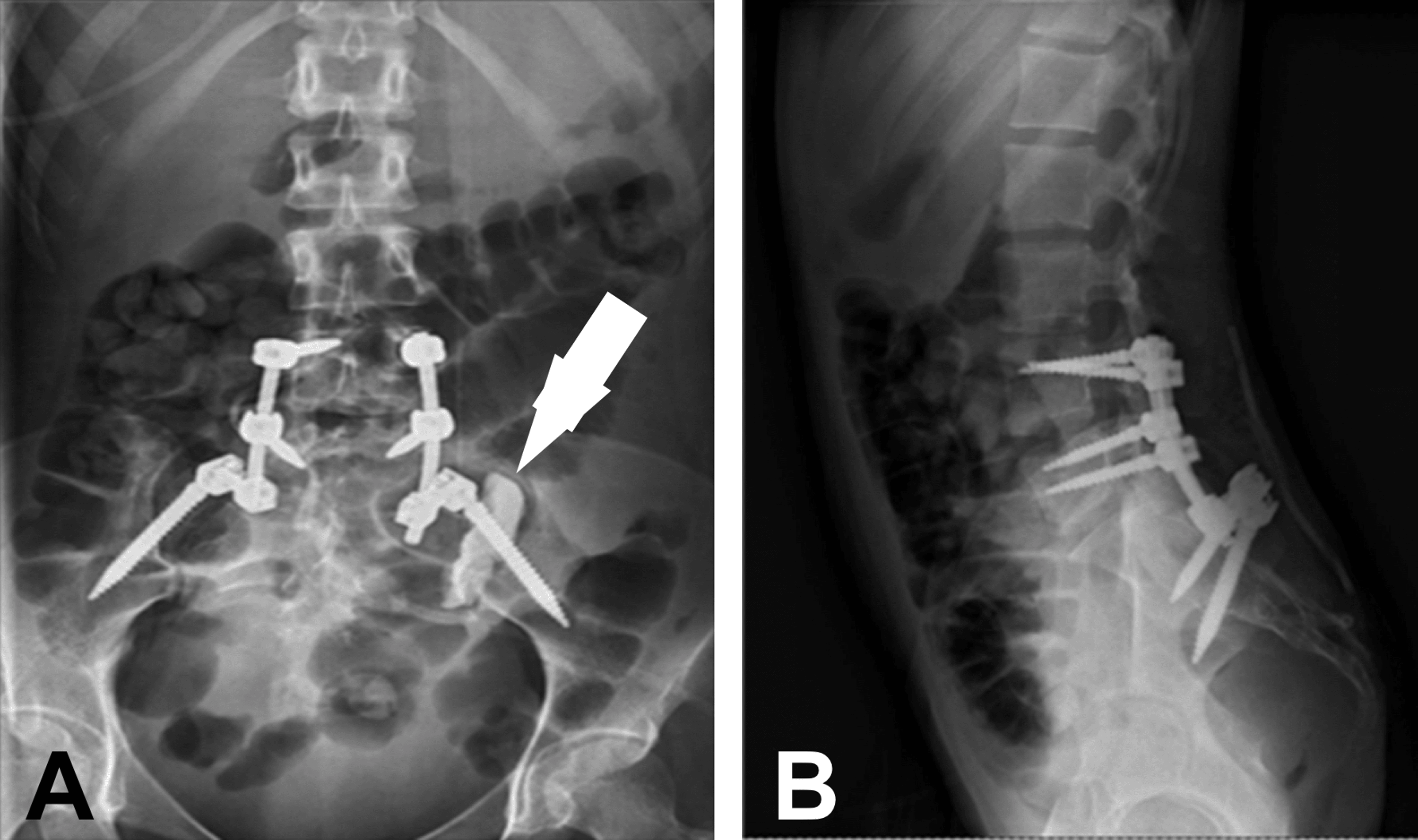 A Case Report Of A Sacral Giant Cell Tumor Treated With Block Resection ...