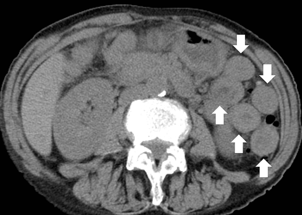 Multiple White Plaques in the Esophagus A Possible Case of Esophageal
