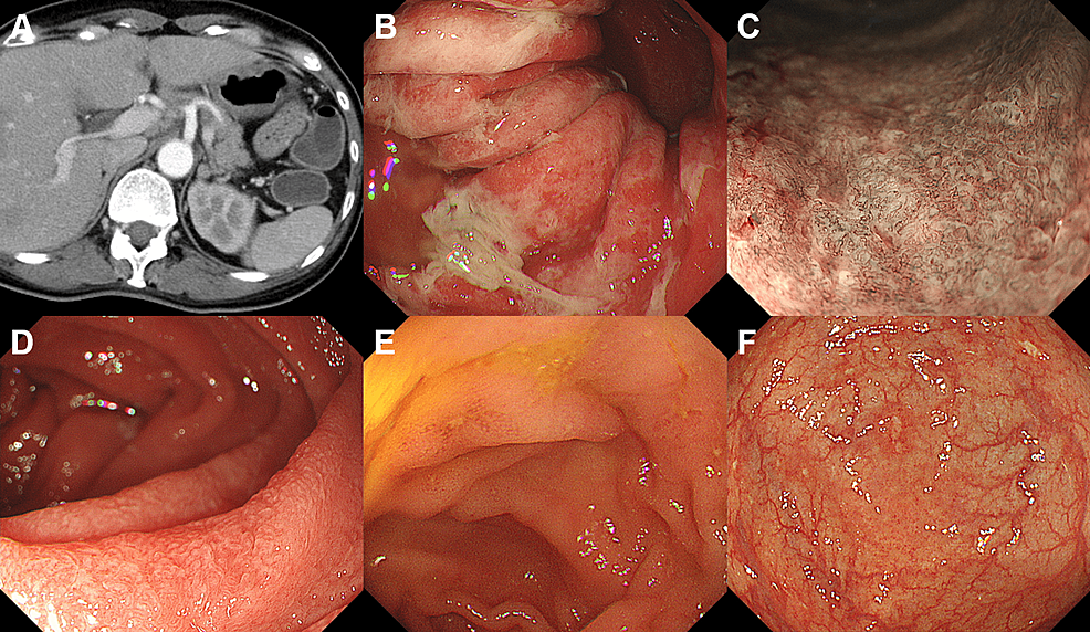Cureus Multiple White Plaques in the Esophagus A Possible Case of