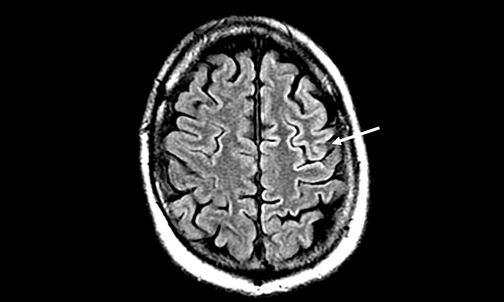 Creutzfeldt-Jakob Disease: A Case Report And Literature Review For ...