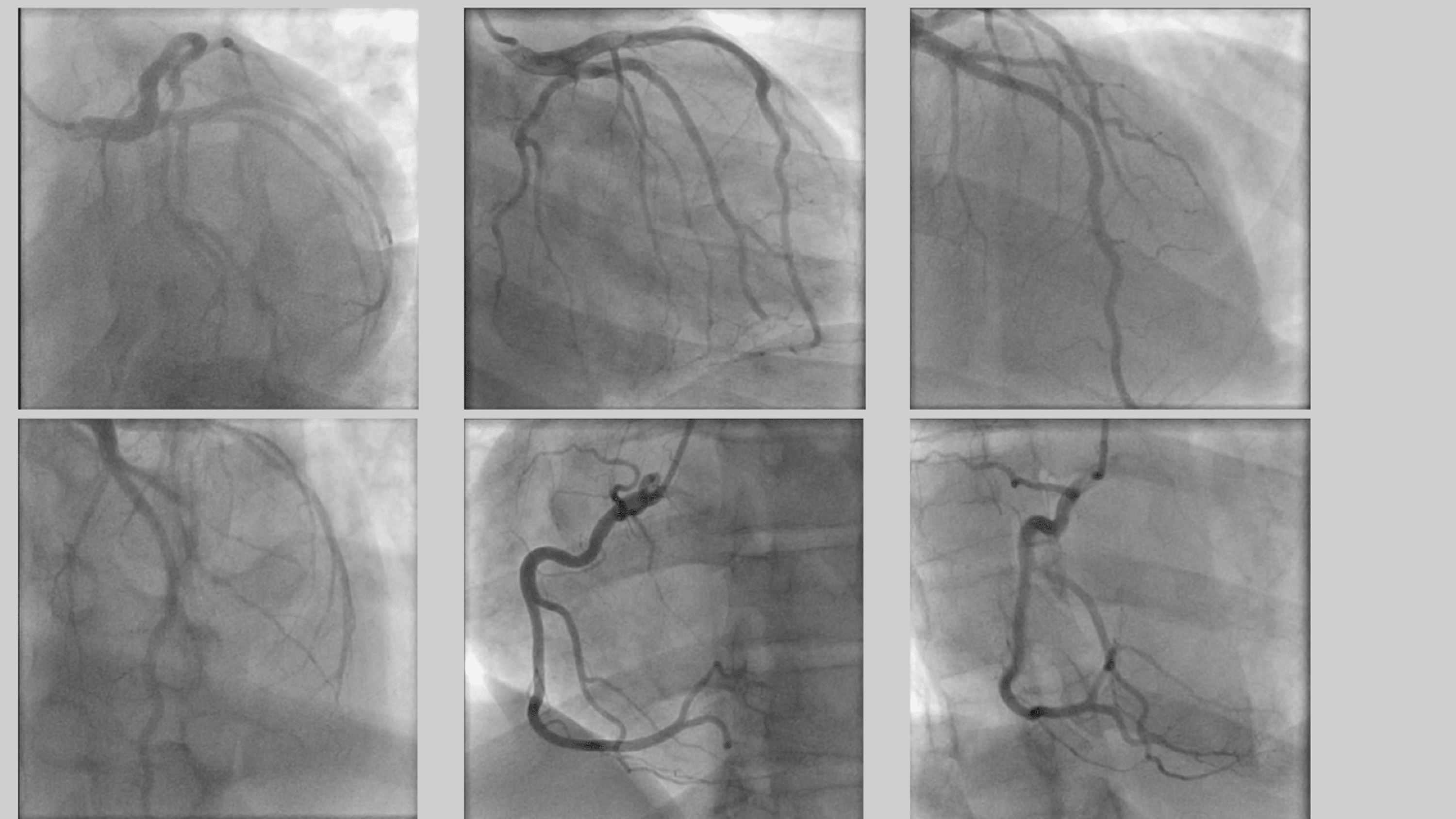Cureus Unusual Cause of a Cardiac Arrest in a Former African American