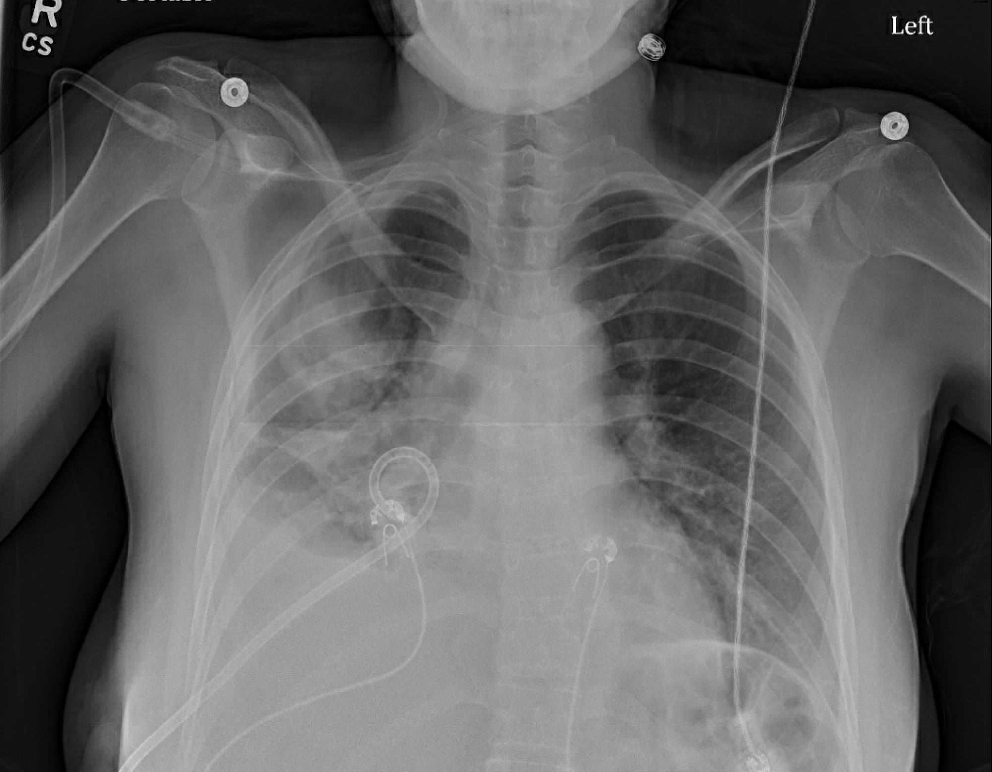 Cureus Sputum Smear And Culture Negative Tuberculosis With Associated