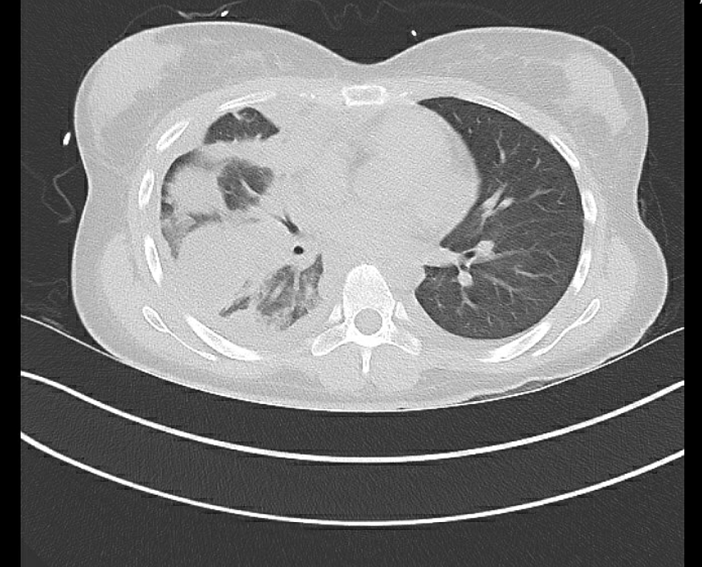 Cureus Sputum Smear And Culture Negative Tuberculosis With Associated