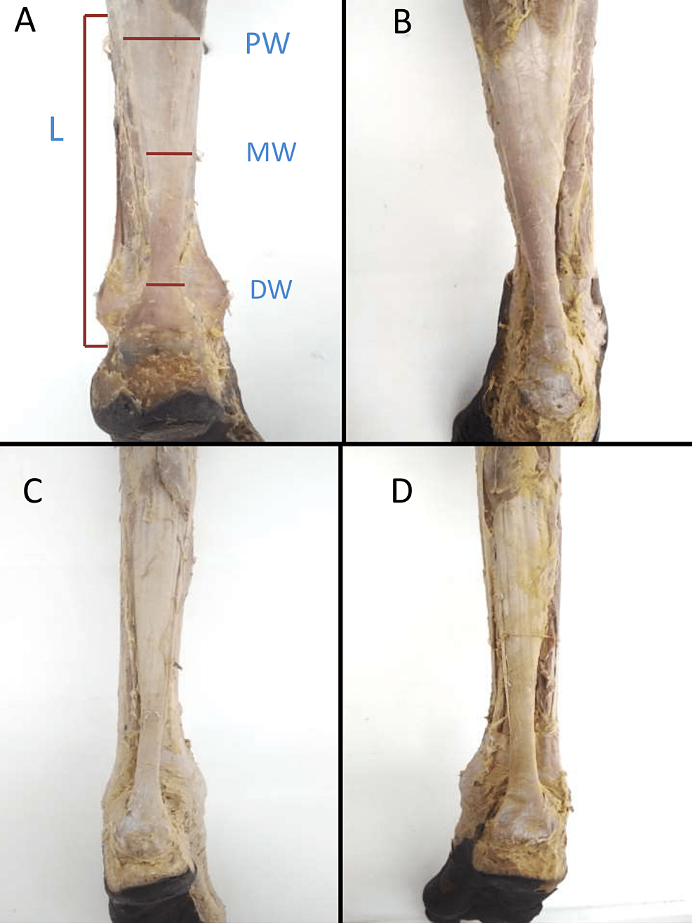 Morphometric Analysis Of Achilles Tendon Structure And Its Significance ...