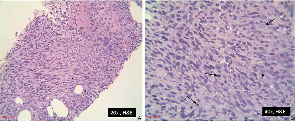 Cureus | A 20.5 cm Malignant Peripheral Nerve Sheath Tumor of the ...