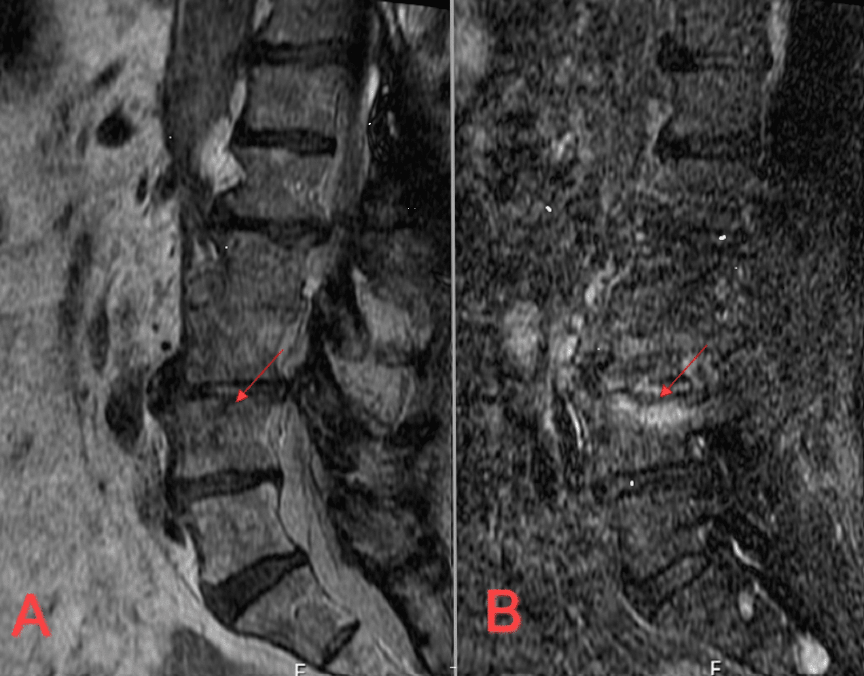 Cureus Lumbar Spine Osteomyelitis After Permanent Spinal Cord