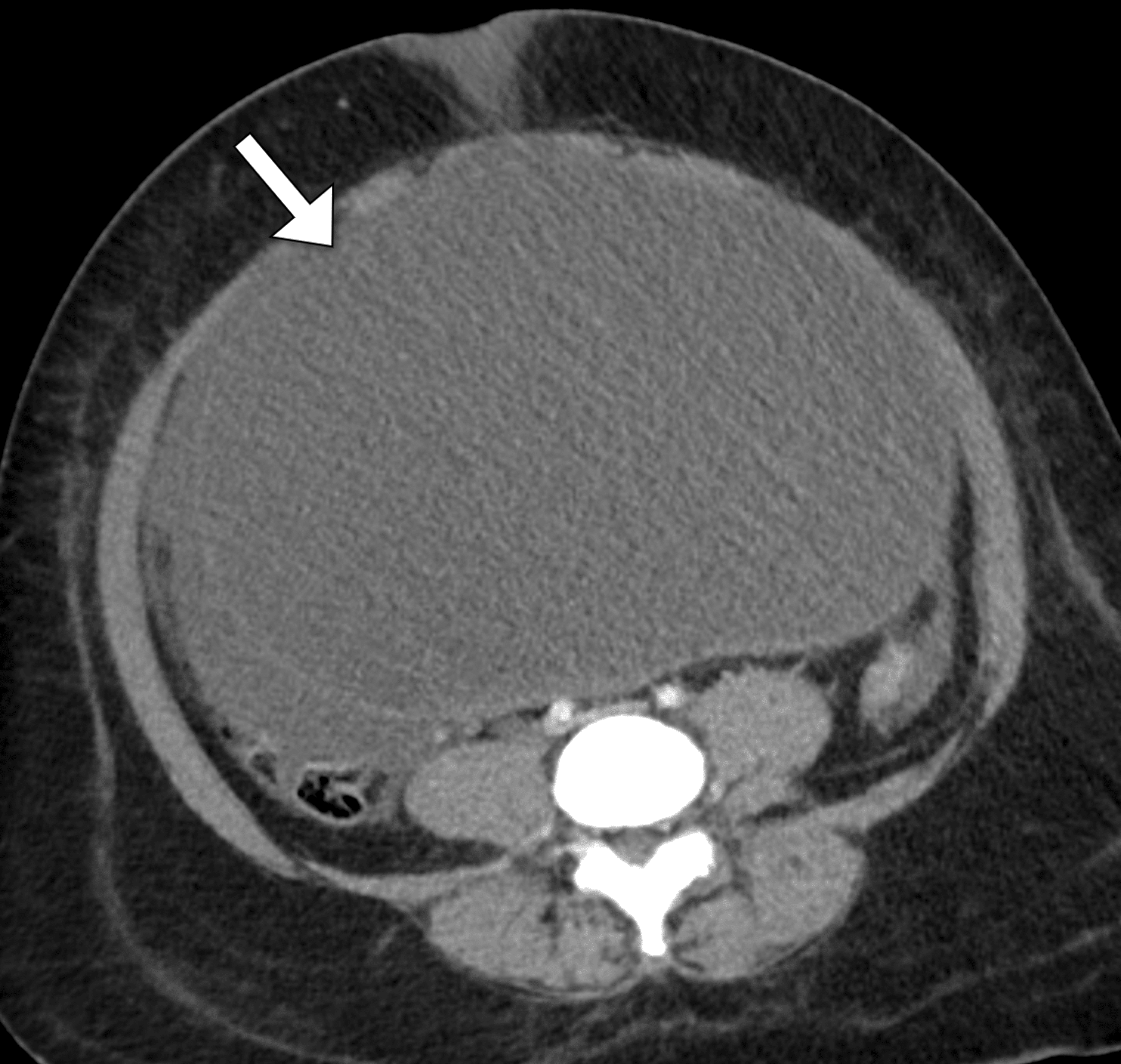 Abdominal Compartment Syndrome Due To Subcutaneous Em vrogue.co
