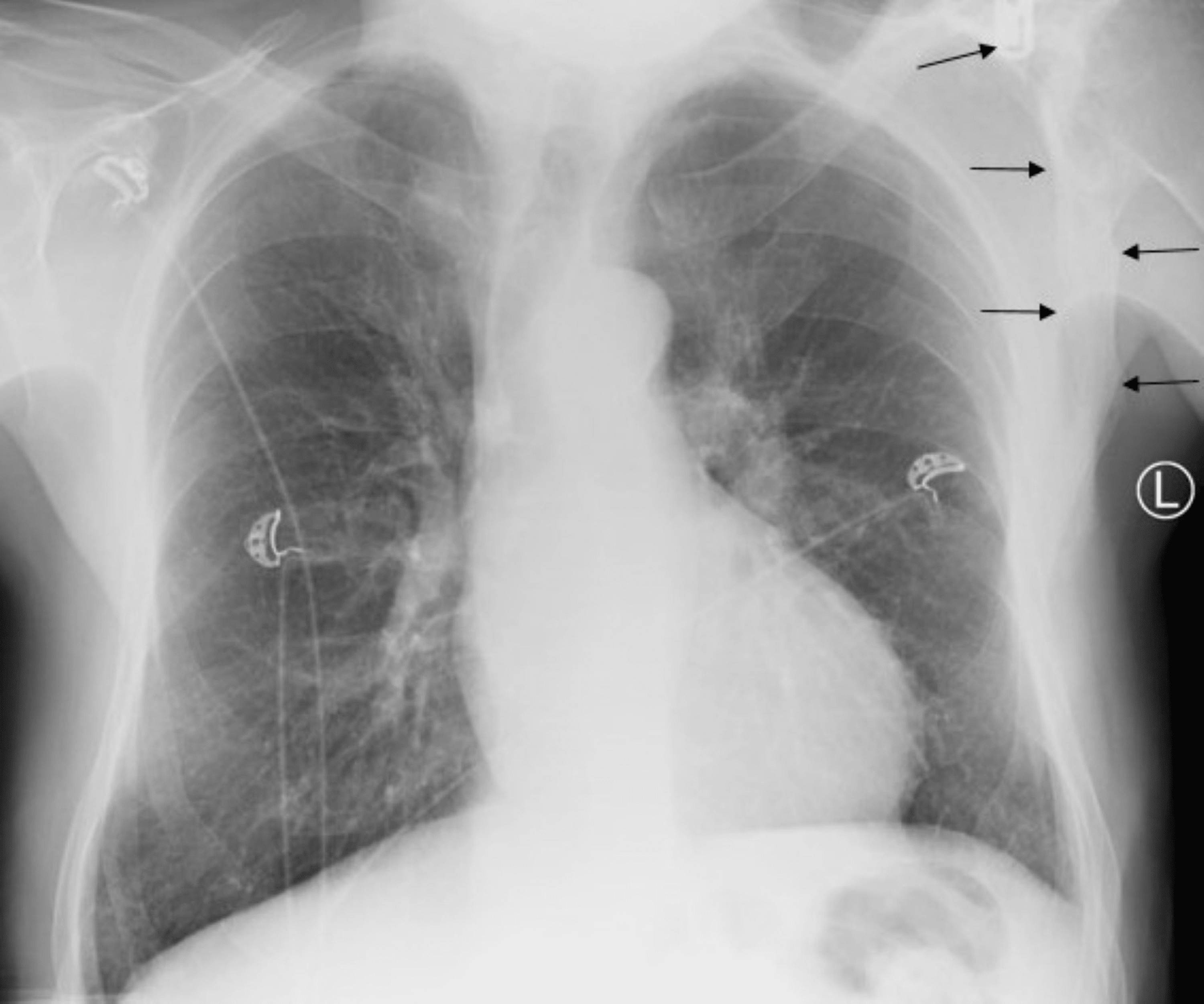 Cureus | Monostotic Paget's Disease Involving the Scapula Encountered ...