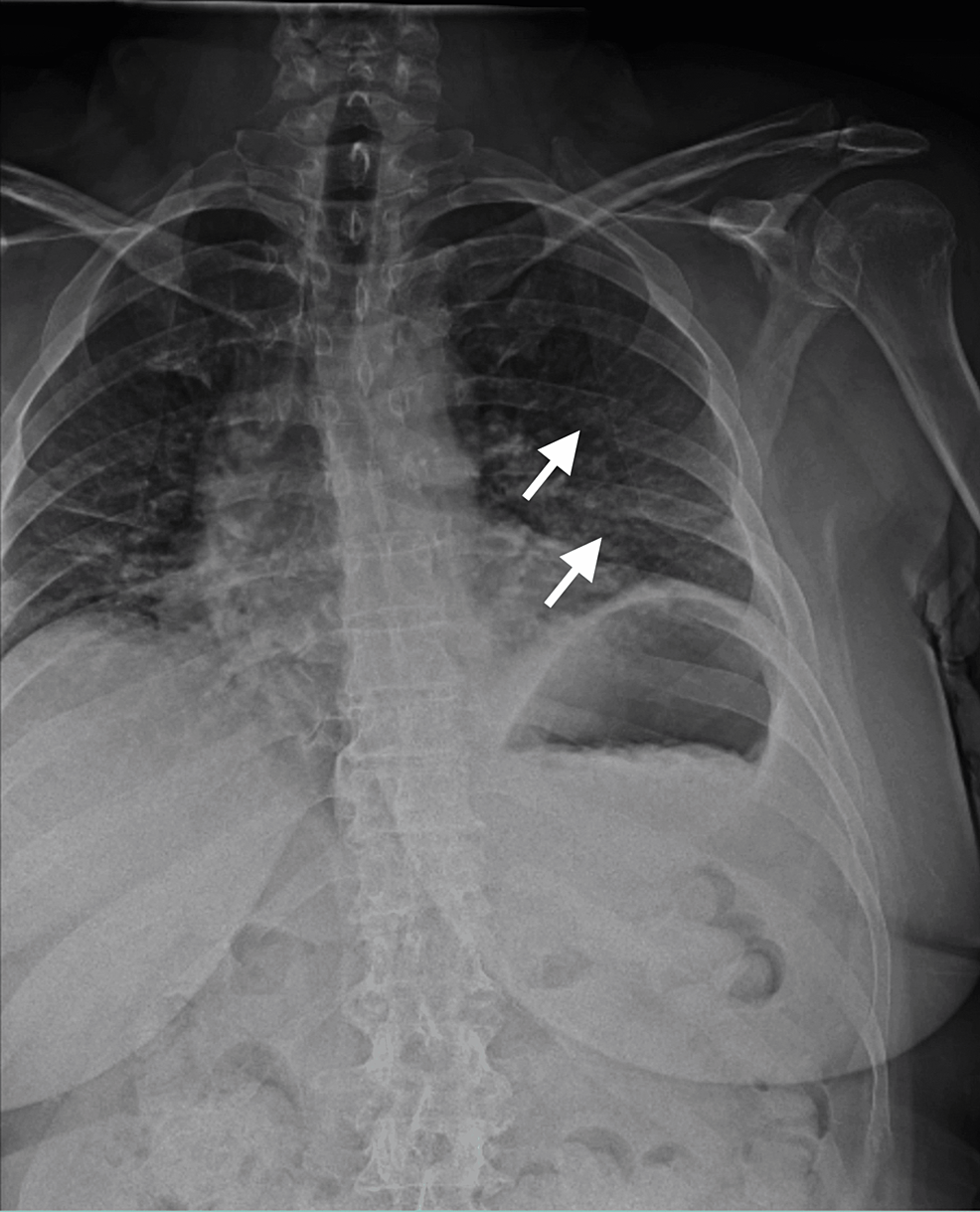 Cureus Outpatient Surgery For Rib Fracture Fixation A Report Of Three Cases