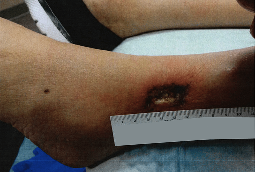 Lower-extremity-ulceration-three-weeks-after-the-initial-presentation-at-the-wound-care-clinic