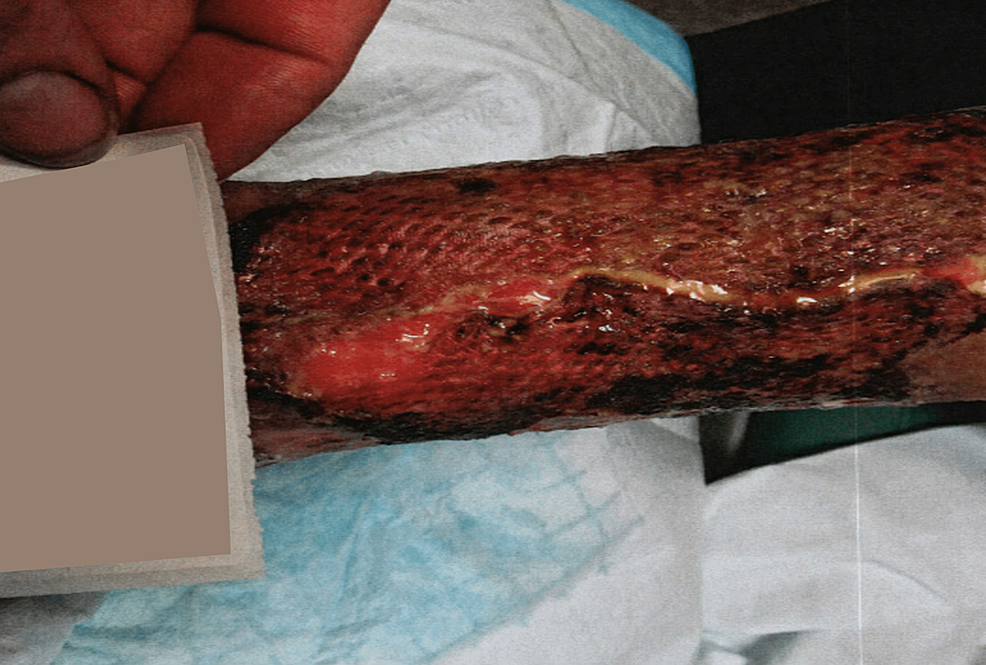 Lower-extremity-ulceration-two-weeks-after-autologous-split-skin-graft-application