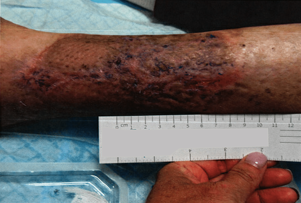 Lower-extremity-ulceration-three-and-a-half-months-after-autologous-split-skin-graft-application