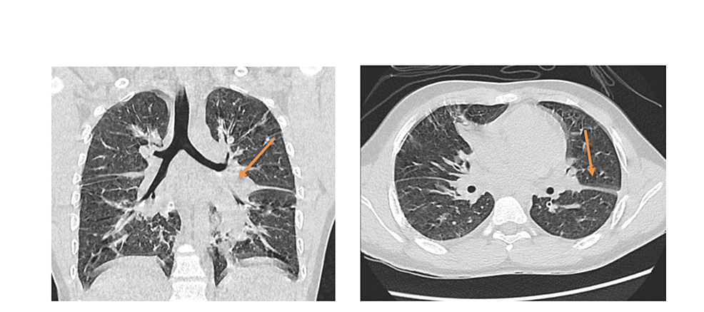 cureus-midwakh-associated-acute-lung-injury-mali-in-a-14-year-old