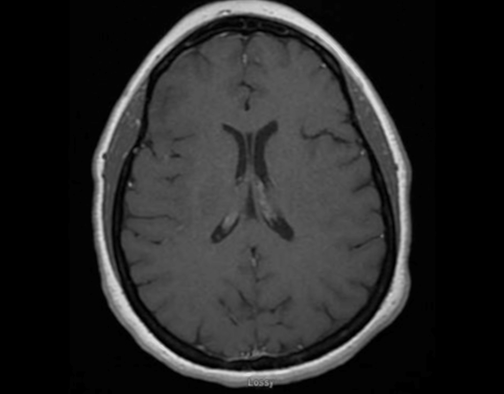 Preoperative-T1-axial-magnetic-resonance-imaging-of-the-brain.