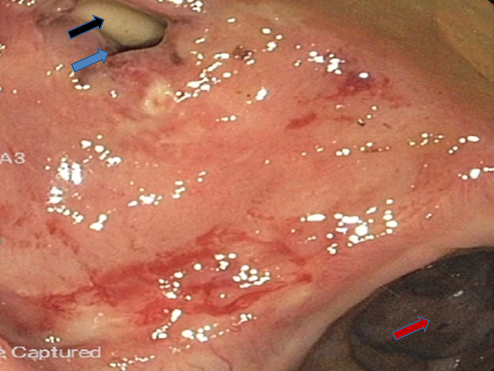 Colonoscopy-revealing-the-catheter-in-the-rectourethral-fistula-and-partially-present-in-the-rectum