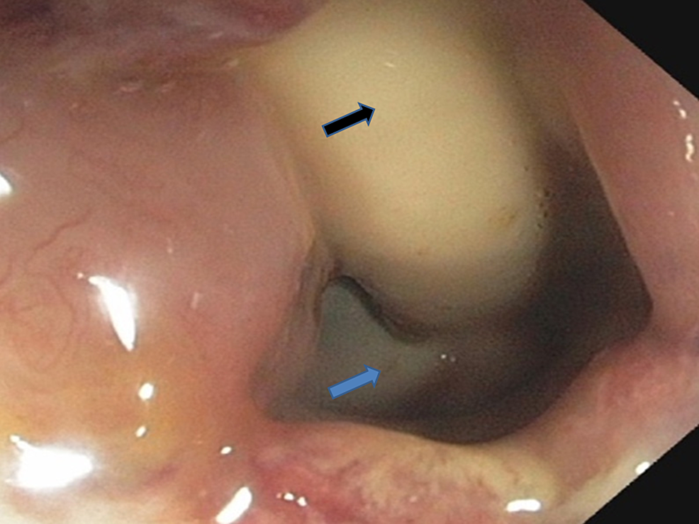 Closer-view-of-the-rectourethral-fistula-with-Foley's-catheter