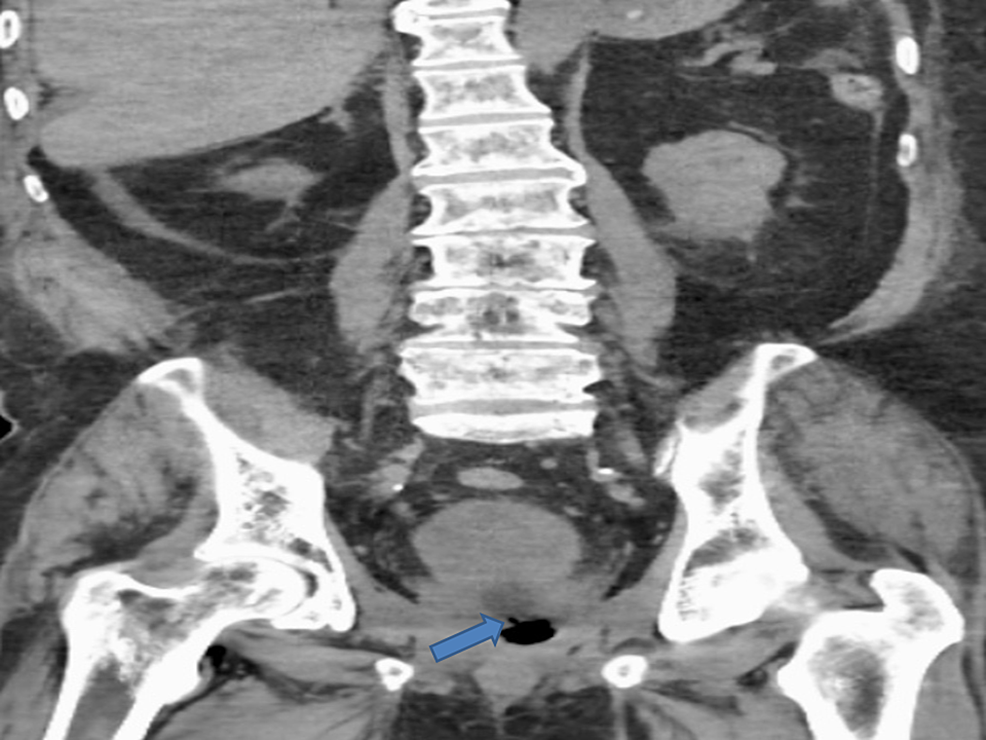 Computed-tomography-(CT)-abdomen-and-pelvis-revealed-the-rectourethral-fistula