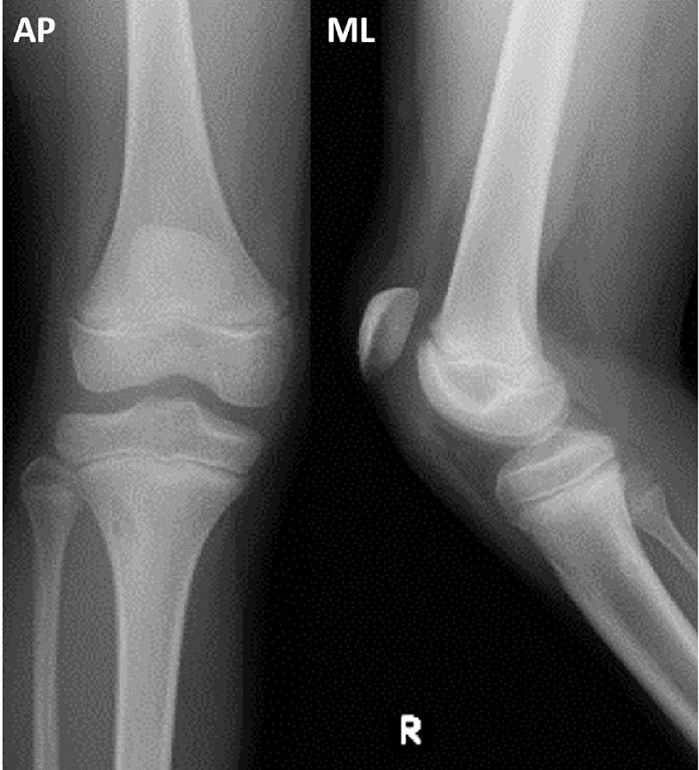 Inferior Pole Sleeve Fracture of the Patella in an Adolescent: A Case ...