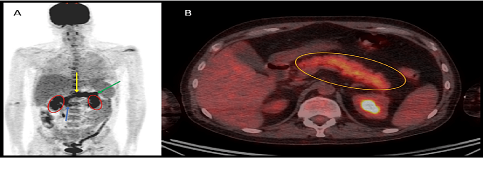 A.-PET-CT-planar-image-showing-diffuse-uptake-in-the-pancreas,-which-is-projected-between-the-kidneys-(red-ovals).-The-blue-arrow-shows-the-pancreas-head,-the-yellow-arrow-the-pancreas-body,-and-the-green-arrow-the-pancreas-tail.-B.-Fused-axial-PET-CT-showing-the-pancreas-outlined-by-the-orange-oval,-with-diffuse-FDG-uptake-within-the-pancreatic-parenchyma