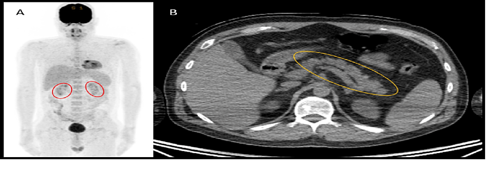 Normal-PET-CT-planar-image-six-months-post-COVID-recovery-showing-kidneys-outlined-by-red-oval-shapes,-and-no-abnormal-FDG-uptake-centrally-in-the-region-of-the-pancreas.-B.-The-pancreas-(orange-oval)-has-a-normal-morphology-on-CT-with-no-calcification-to-suggest-chronic-pancreatitis