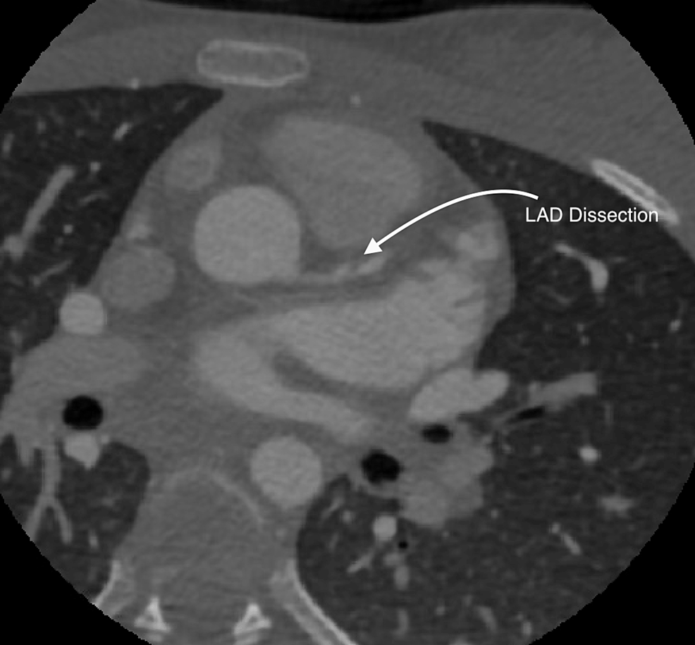 cureus-traumatic-left-anterior-descending-artery-dissection-in-a-case