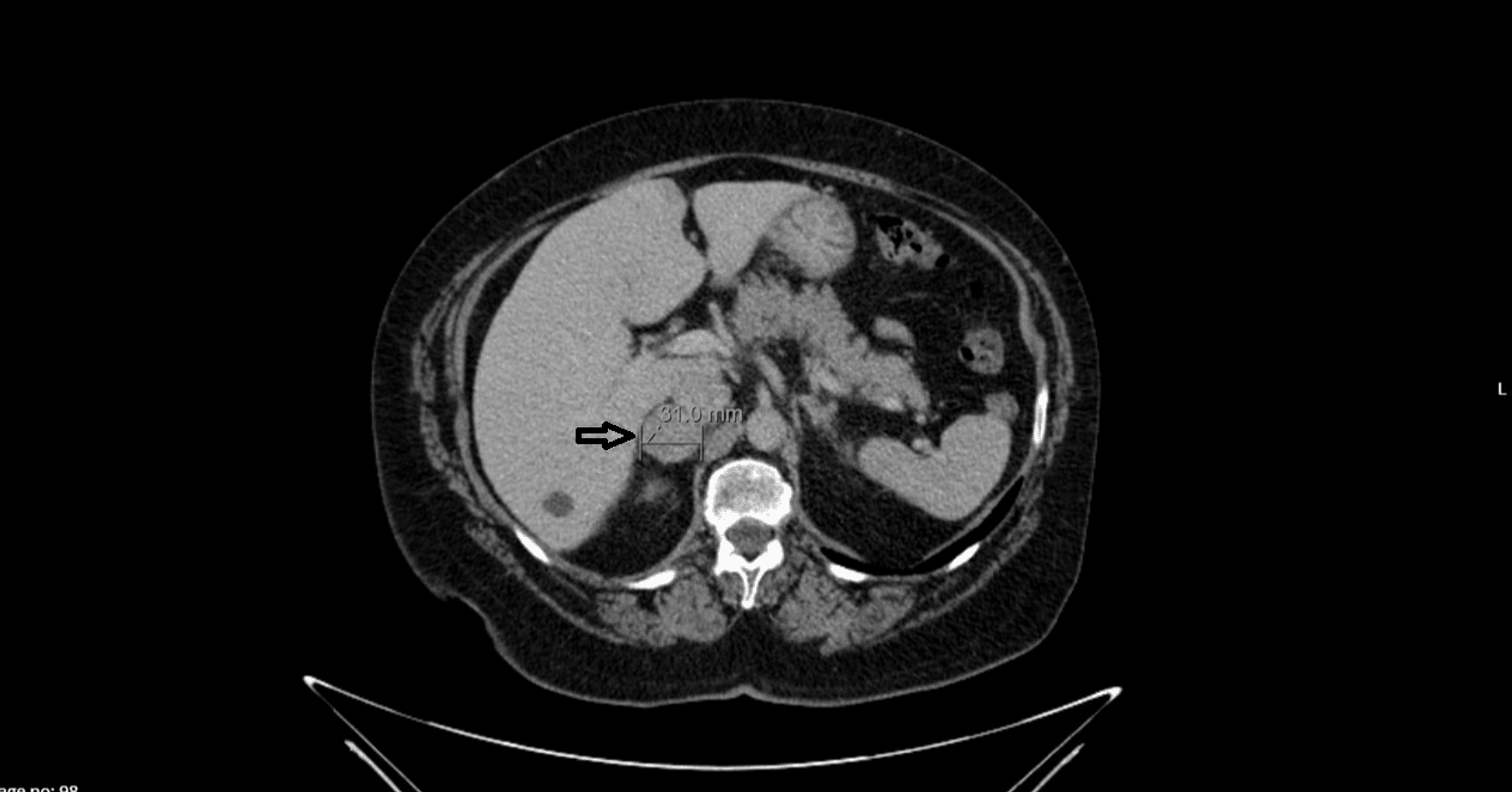 Cureus Pheochromocytoma A Case Report 7749