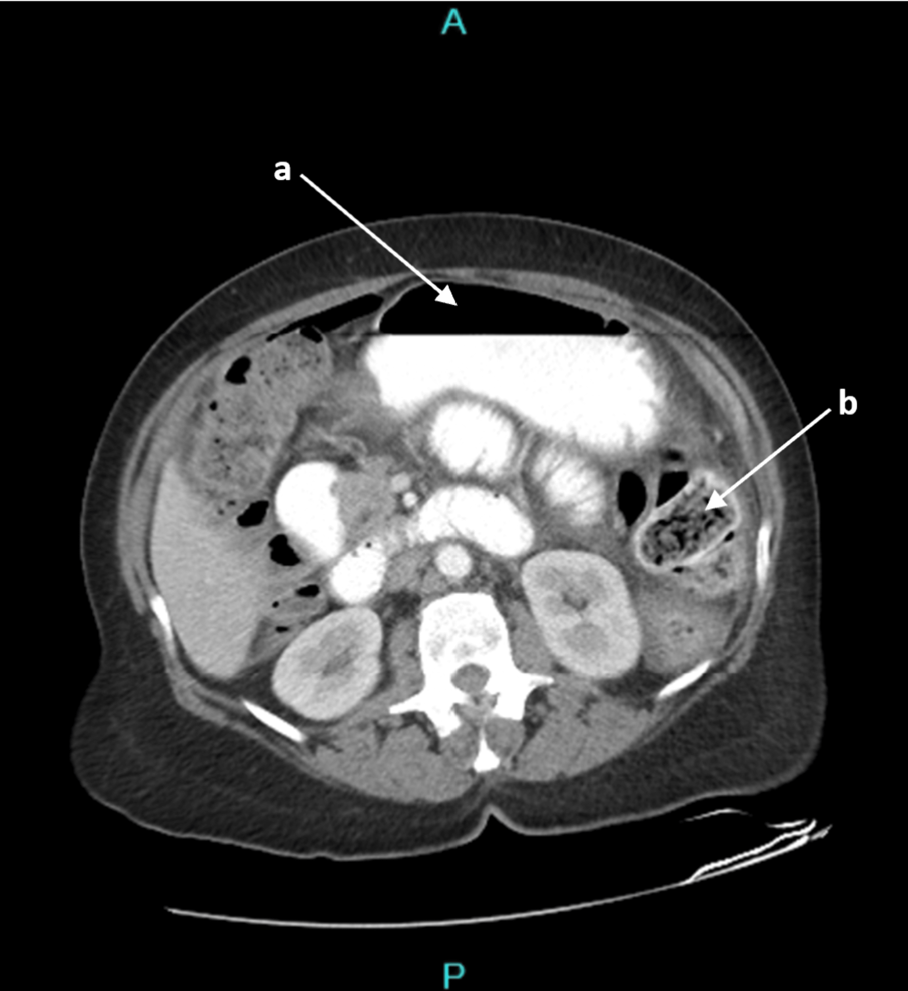 Cureus Stercoral Perforation In The Setting Of Chronic Antipsychotic Use A Case Report