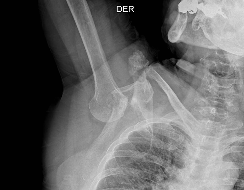Radiograph of right shoulder