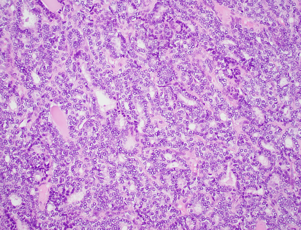 Cureus NRAS Gene Mutation in Differentiated HighGrade Thyroid