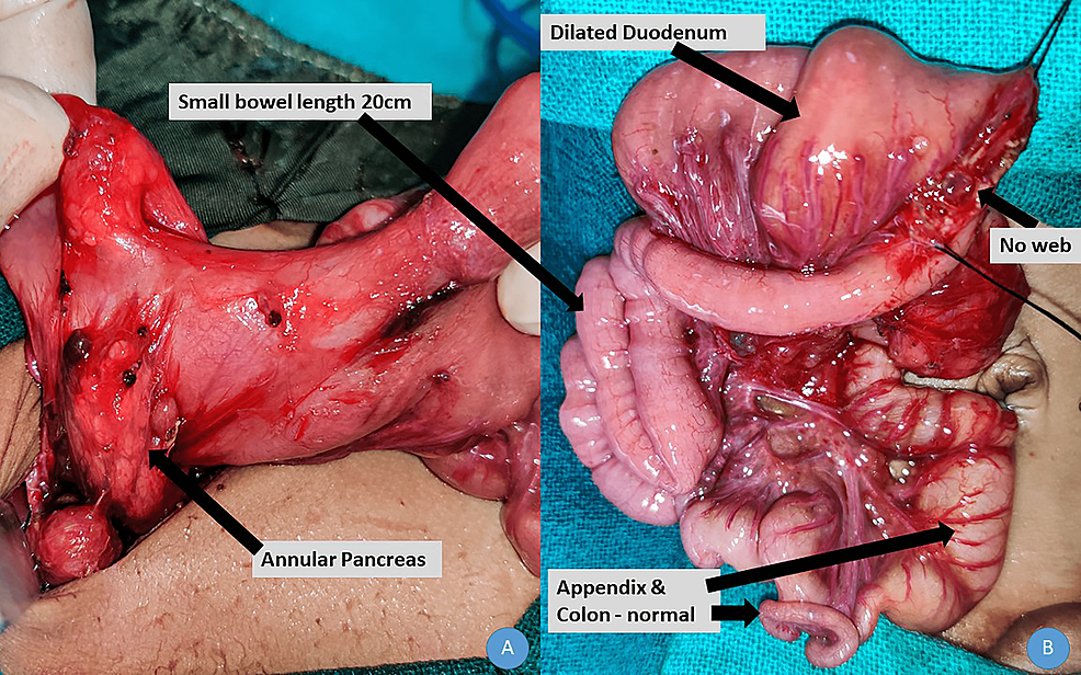 Operative-photograph-depicting-the-dilated-duodenum,-the-presence-of-annular-pancreas,-short-small-intestine,-and-normal-colon