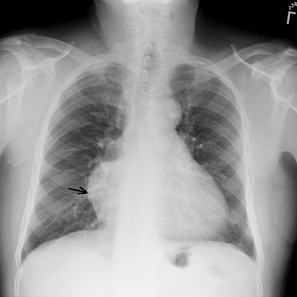 Cureus | Giant Right Coronary Artery Aneurysm: A Case Report