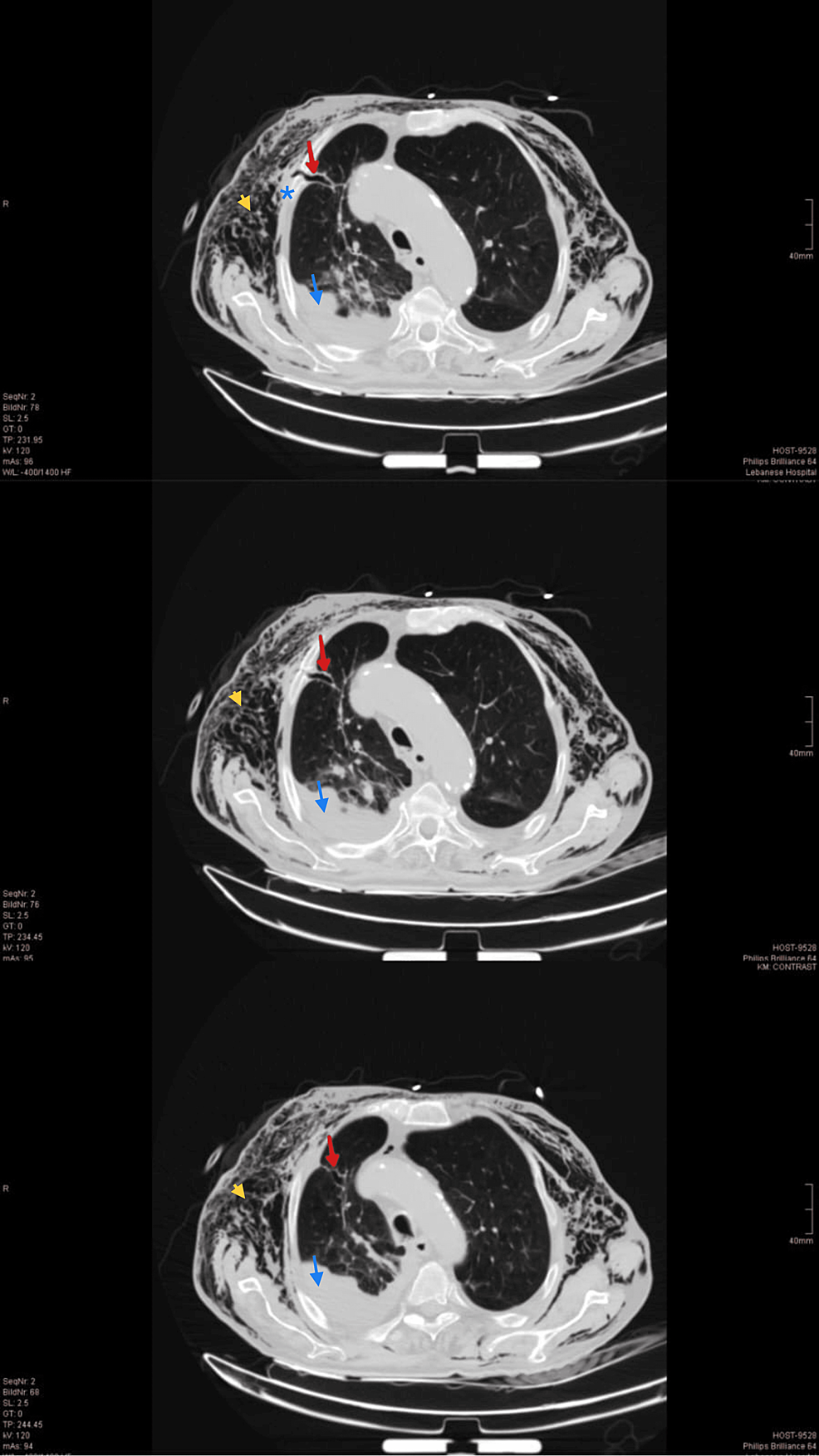 Cureus Extensive Subcutaneous Emphysema Posttraumatic Tube Thoracostomy